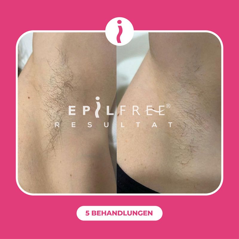 Epilfree angewendet bei den Achseln nach dem Sugaring für schneller Ergebnisse