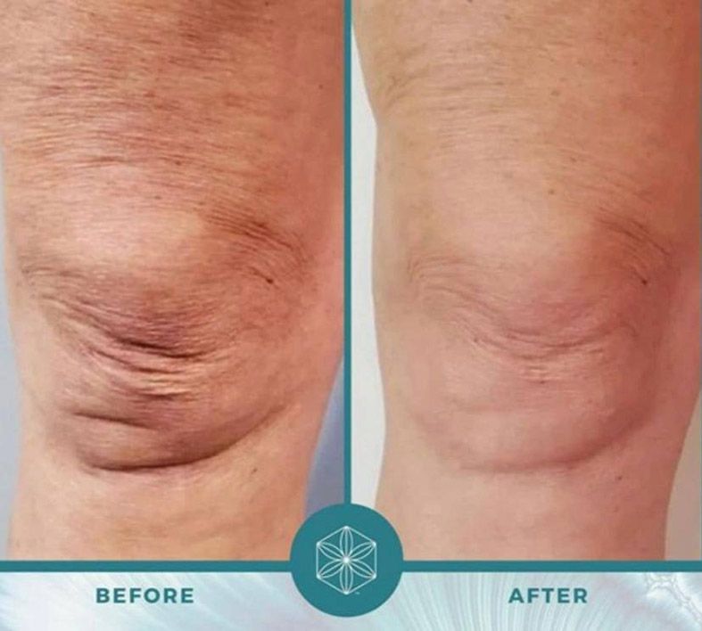 Isagenix Collagen Elixier Knieveränderung Before und After