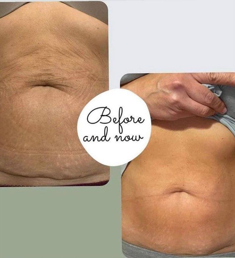 Isagenix Collagen Elixier Before and now von einem Bauch mit Schwangerschaftsstreifen